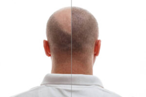 Hair Transplant in Riyadh