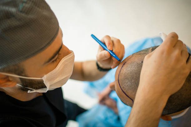Hair transplant in Dubai