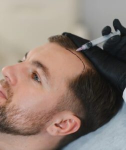 hair transplant in dubai