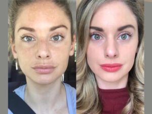 Radiofrequency (RF) Microneedling in Dubai