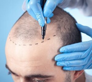 hair transplant in Dubai (9)