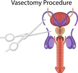 No Scalpel Vasectomy and Ultrasound-Based Vas Deferens Mapping Precision